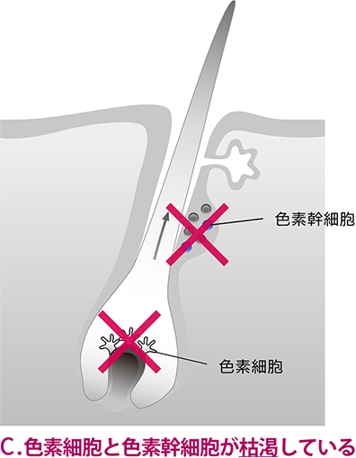 色素細胞と色素幹細胞が枯渇している場合