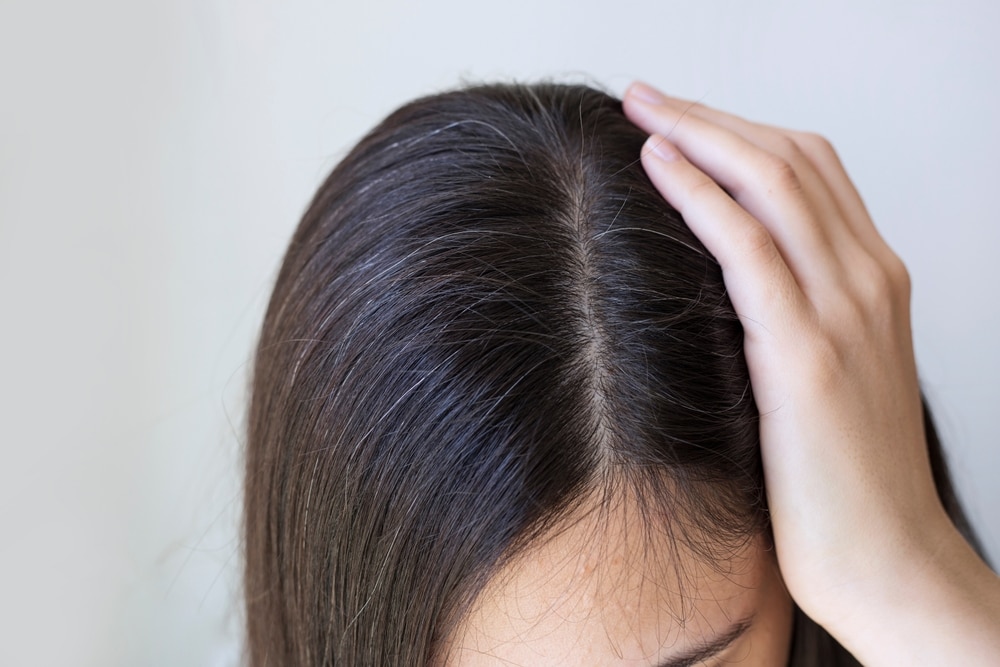 生え際の白髪