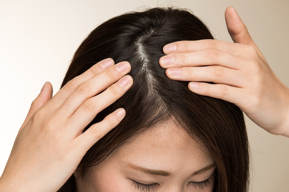 産後の抜け毛は「産後脱毛症」と呼ばれる一時的な現象